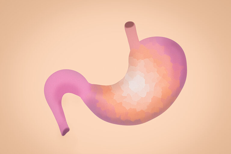 Hypochlorhydria: faibles symptômes, causes et traitements d'acide de l'estomac
