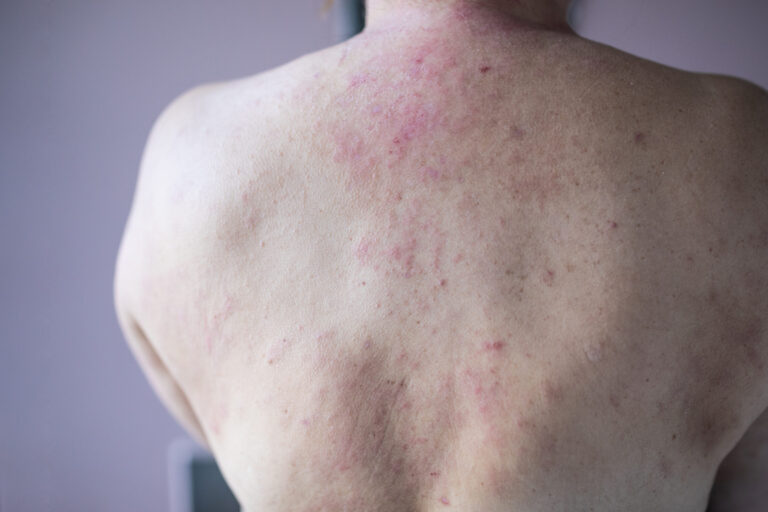 Rash de chaleur: symptômes, causes et traitements
