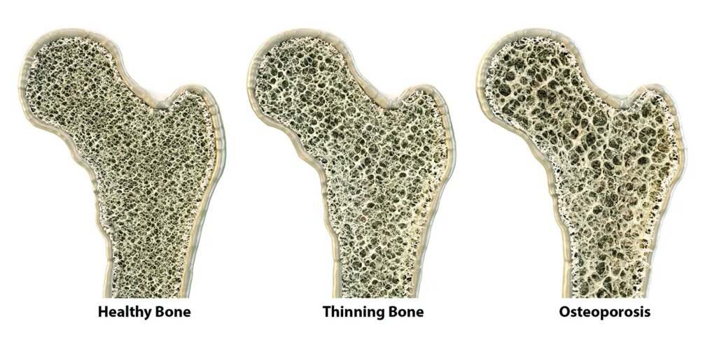 Osteoporosis Medications