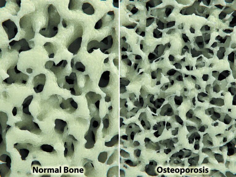 osteopenia