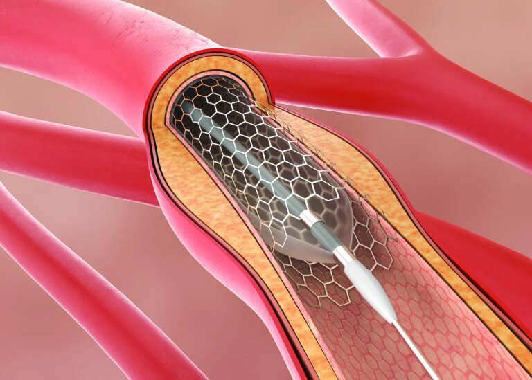 heart stent