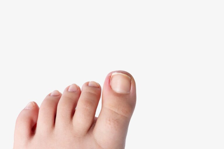 Ingrown Toenail