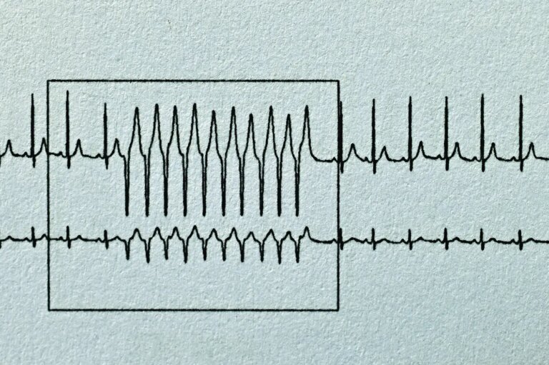 Tachycardia