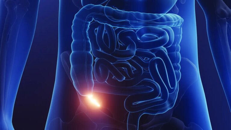 Appendicitis
