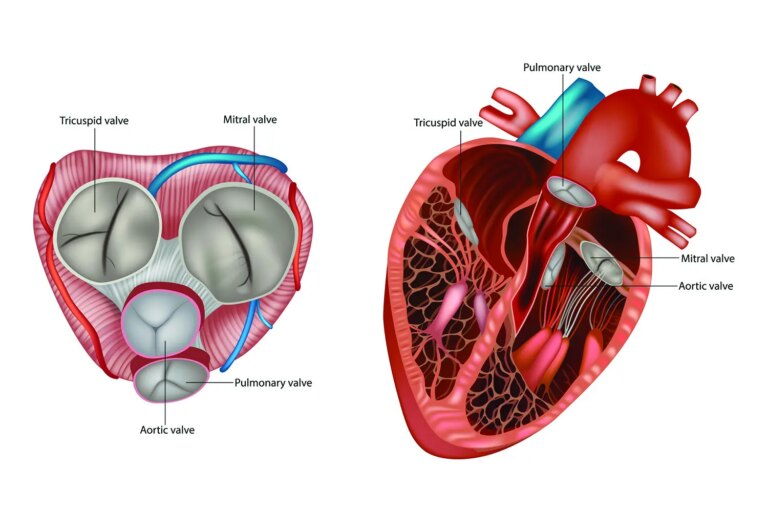 Mitral Regurgitation