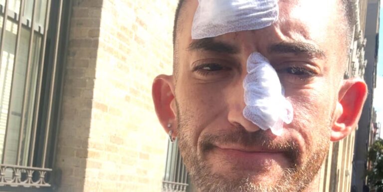J'ai évité la crème solaire lors de mes courses pendant des années. Ensuite, j’ai eu besoin d’une chirurgie du cancer de la peau sur mon visage.
